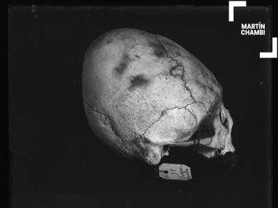 Cráneo trepanado con etiqueta numerada de procedencia. En la etiqueta se inscribe las palabra: 31 Choquebamba[sic]